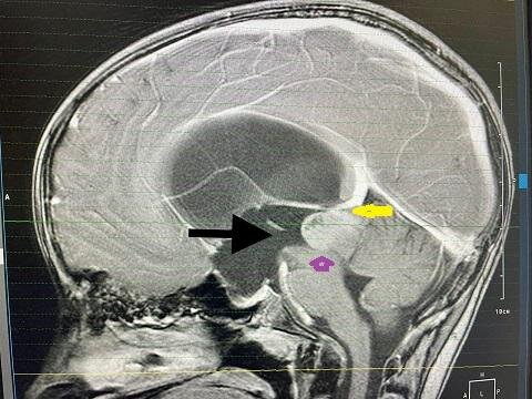 Рис. 1. В пинеальной области с пролабированием в полость третьего желудочка визуализируется  дополнительное объемное образование неправильной  формы, гетерогенной структуры за счет повышения МР-сигнала на Т1-ВИ, с четкими, неровными контурами, размерами до 2.2х2.6х1.8 см, с неравномерным типом контрастирования ( черная стрелка) . Выявляется выраженный масс-эффект в виде деформации прилежащих отделов гиппокампов, окклюзии водопровода мозга, деформации пластинки четверохолмия ( фиолетовая стрелка),   передних отделов среднего мозга, прилежащих отделов червя и обеих гемисфер мозжечка.