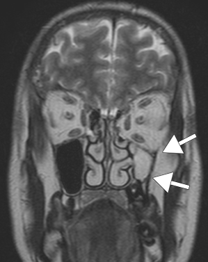 Рис 1. Т2 - ВИ в корональной плоскости. Левая верхнечелюстная пазуха уменьшена в объеме, отмечается втяжение ее передней, нижней и латеральной стенок. Тотальное снижение пневматизации пазухи за счет высокобелкового компонента.