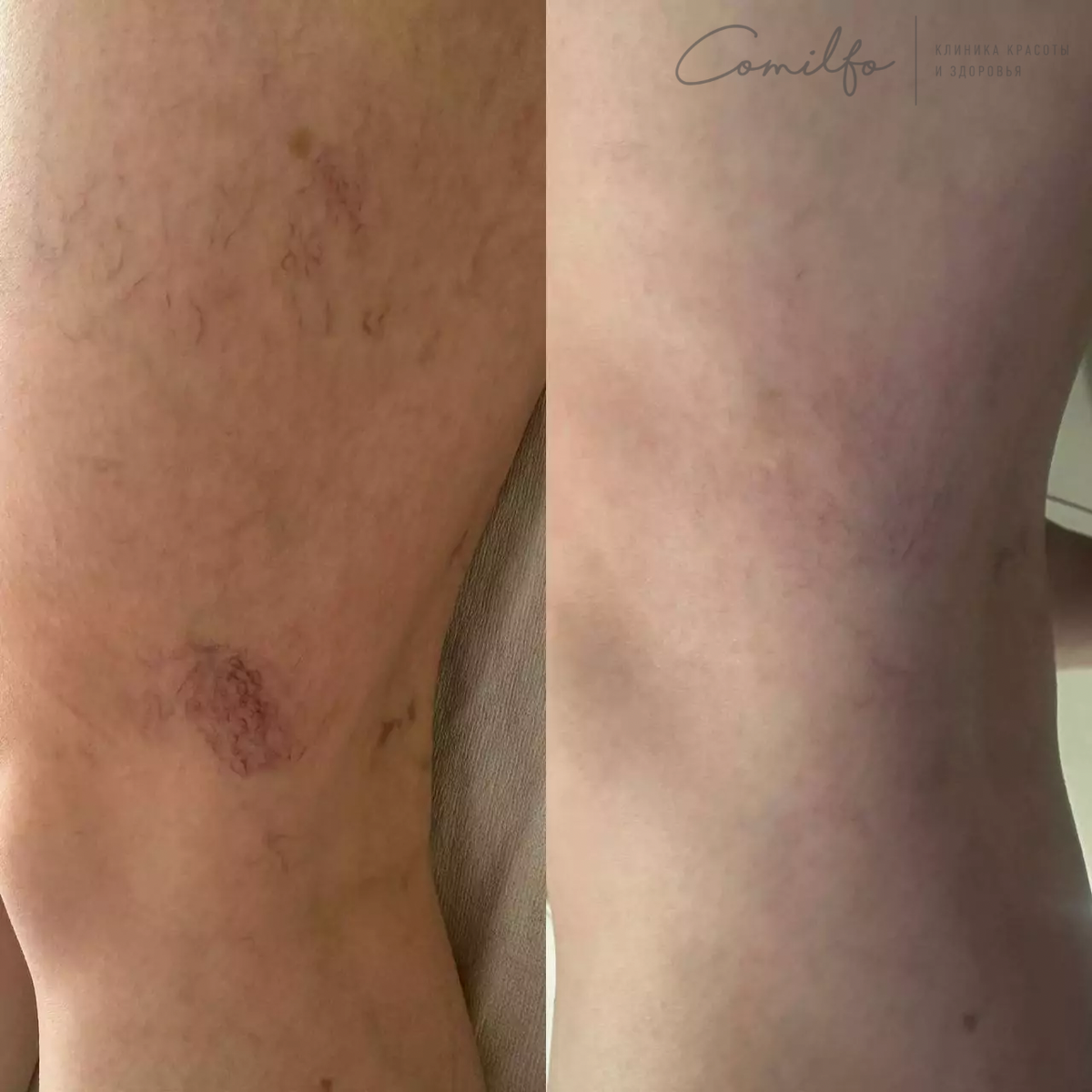 До и через 2 месяца после процедуры