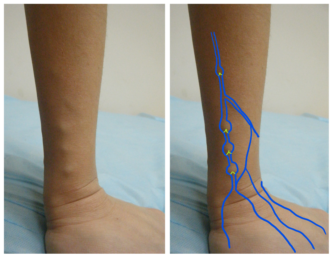 Левое предплечье и кисть.