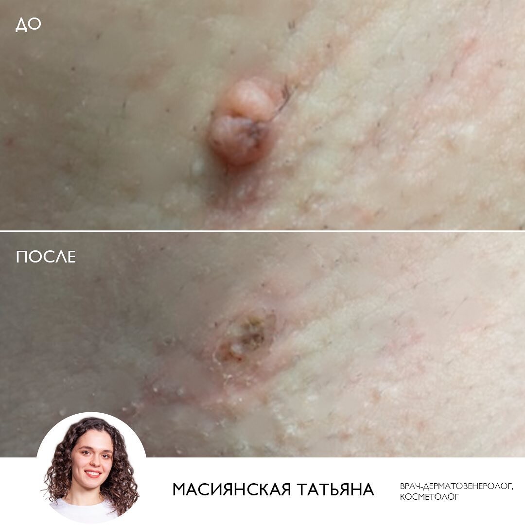 Удаление новообразований в клинике ЭСТЕЛАБ