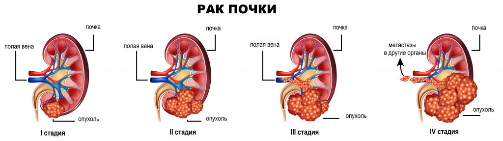 3 стадия рака почки. Малхасян Виген Андреевич уролог.