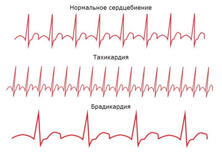 Кто сталкивался? Сильная тахикардия!