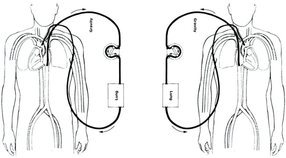   N + 1; Extracorporeal Life Support Organization / Wikimedia Commons / CC BY 2.5 DEED