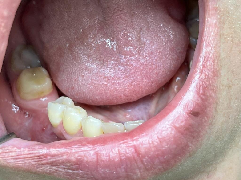 ДО. Слизистая с щечной стороны кости.