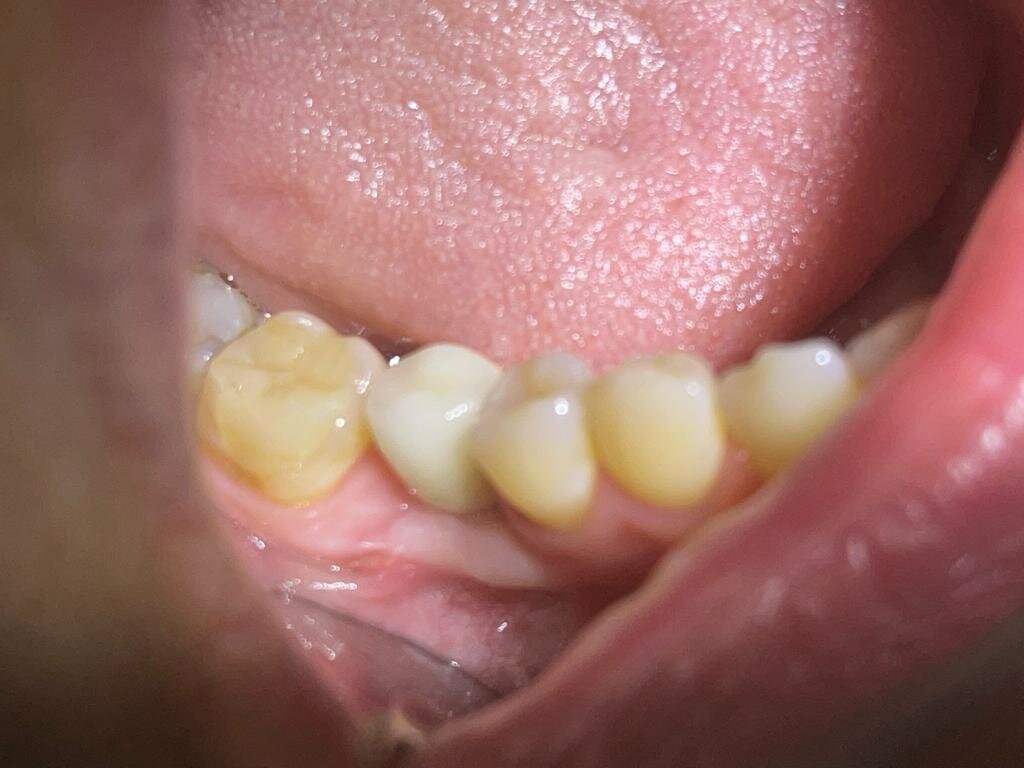 Установлена коронка. 