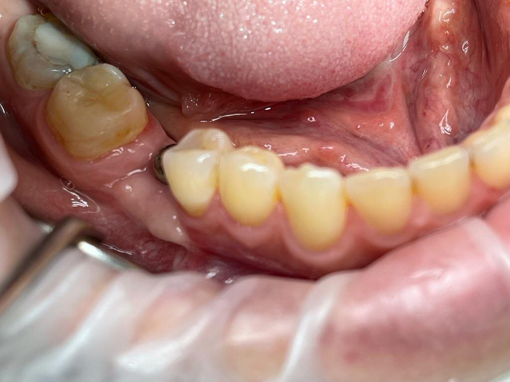 ПОСЛЕ. Через месяц после операции. Слизистая удалена, вместо нее десна. Стоит формирователь десны. 