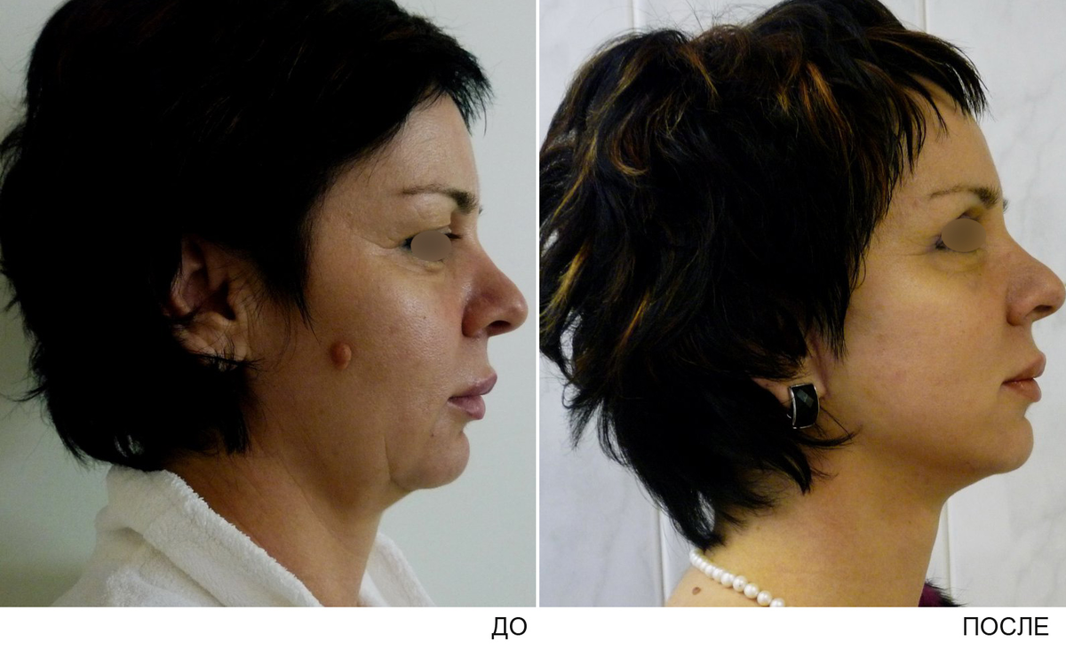 пластика лица воронеж