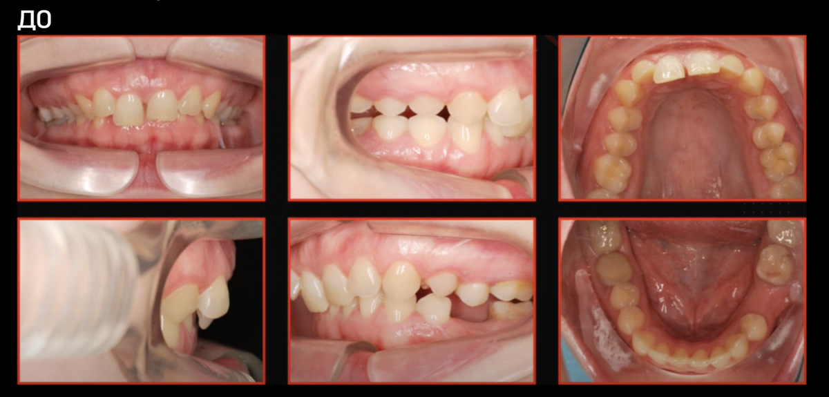 Для чего и как ортодонт применяет разобщающие накладки | НОВОДЕНТА - Мы ...