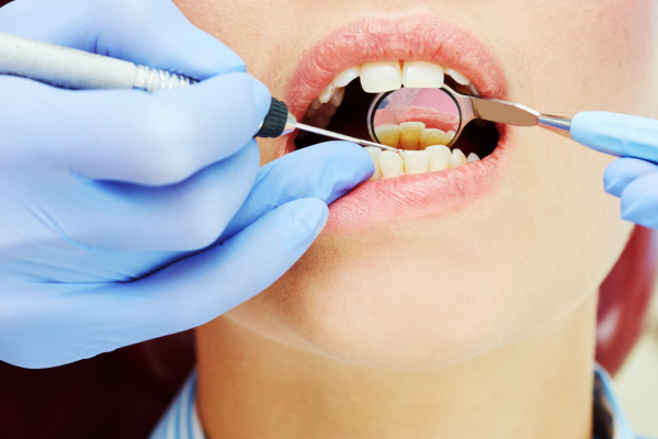 Клиновидный дефект: как укрепить зубы и восстановить их внешний вид ...