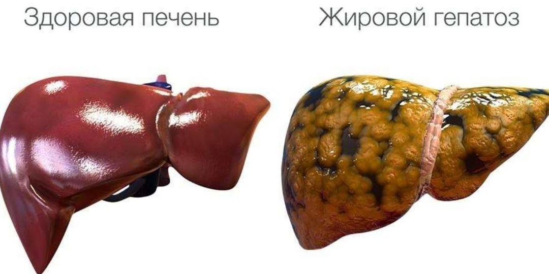 Если на фоне приема статина повысились печеночные ферменты, что делать?