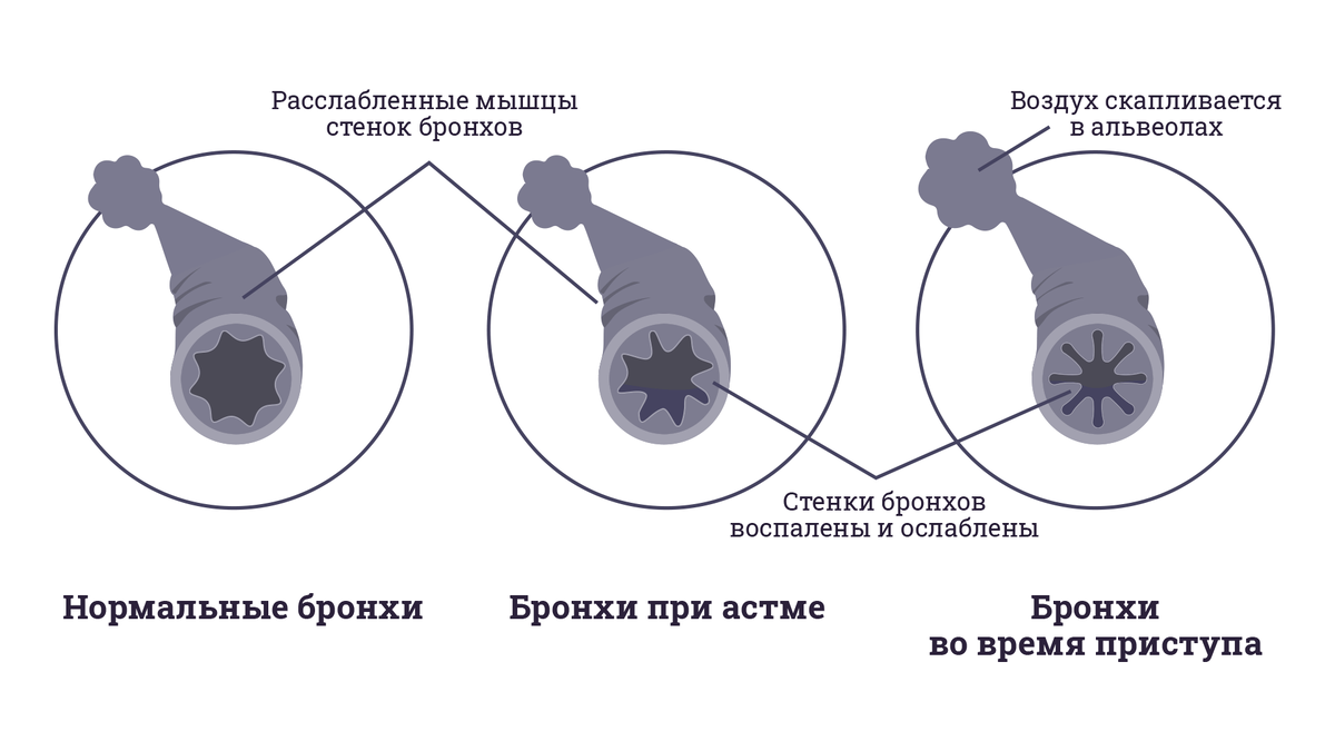 Берут ли в армию с бронхиальной астмой? | ПризываНет | Дзен