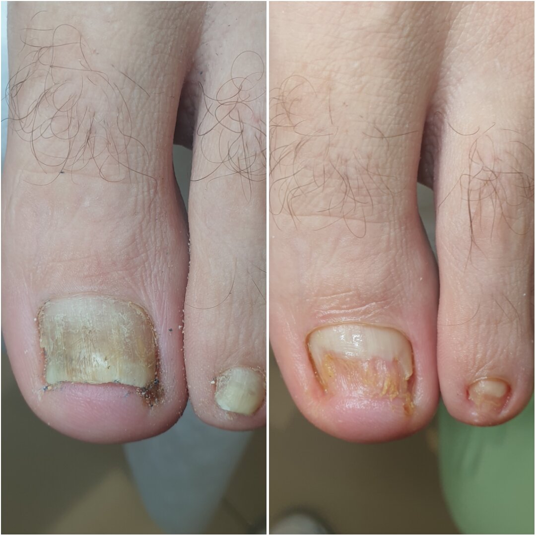 Лечение грибка ногтей дома