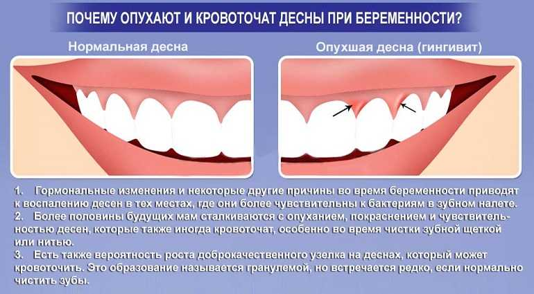 Как снять отек десны в домашних условиях Лечение воспаления десен в Перми цена на услугу в стоматологической клинике ЭС