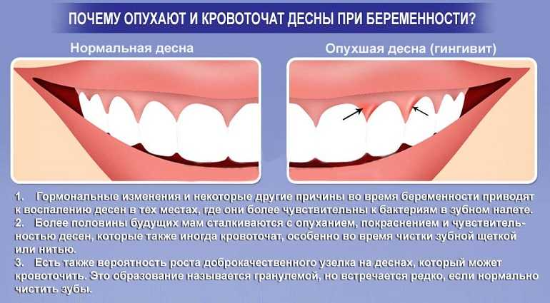 Что делать если кровоточат десна при беременности?