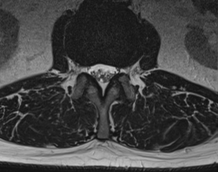 Нормальный позвоночный канал 