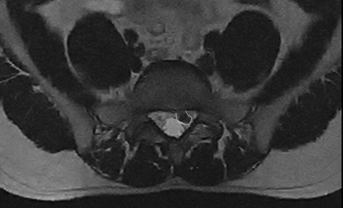 Позвоночный канал, содержащий грыжевое выпячивание (обвел белым контуром).