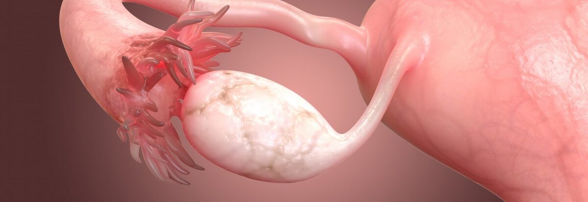 Яичник (белого цвета), маточная труба (с бахромкой) и матка. Изображение из открытых источников. 