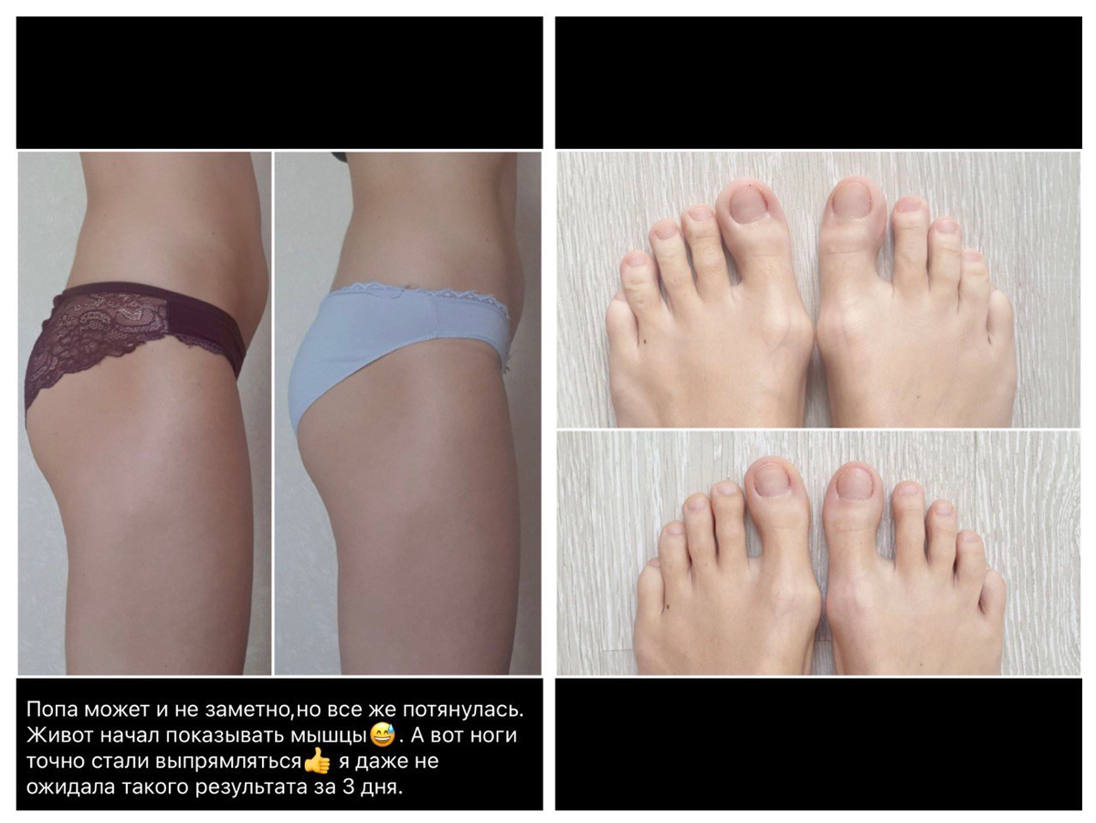 Результат за 3 дня по попе и Halux Valgus.