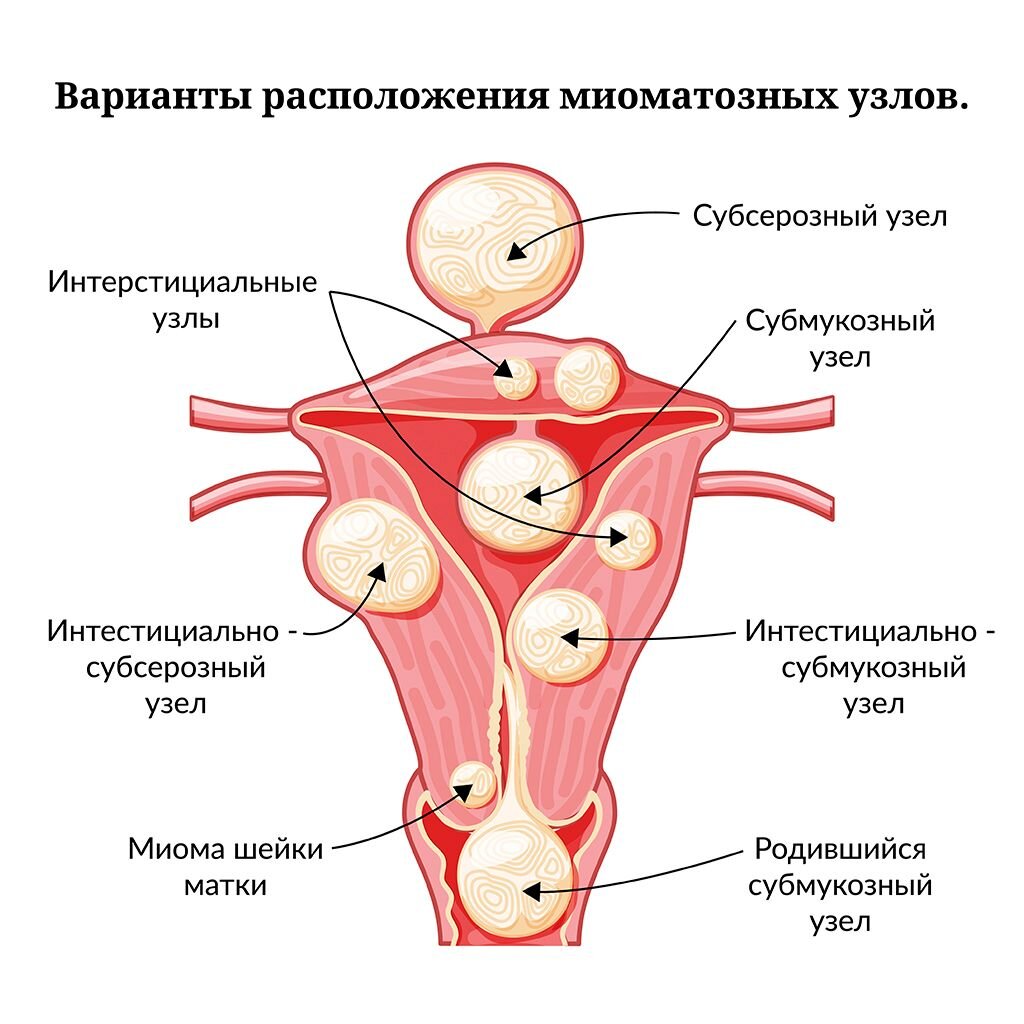 Миома матки — лечение без операции в клинике восточной медицины «Саган Дали» в Москве