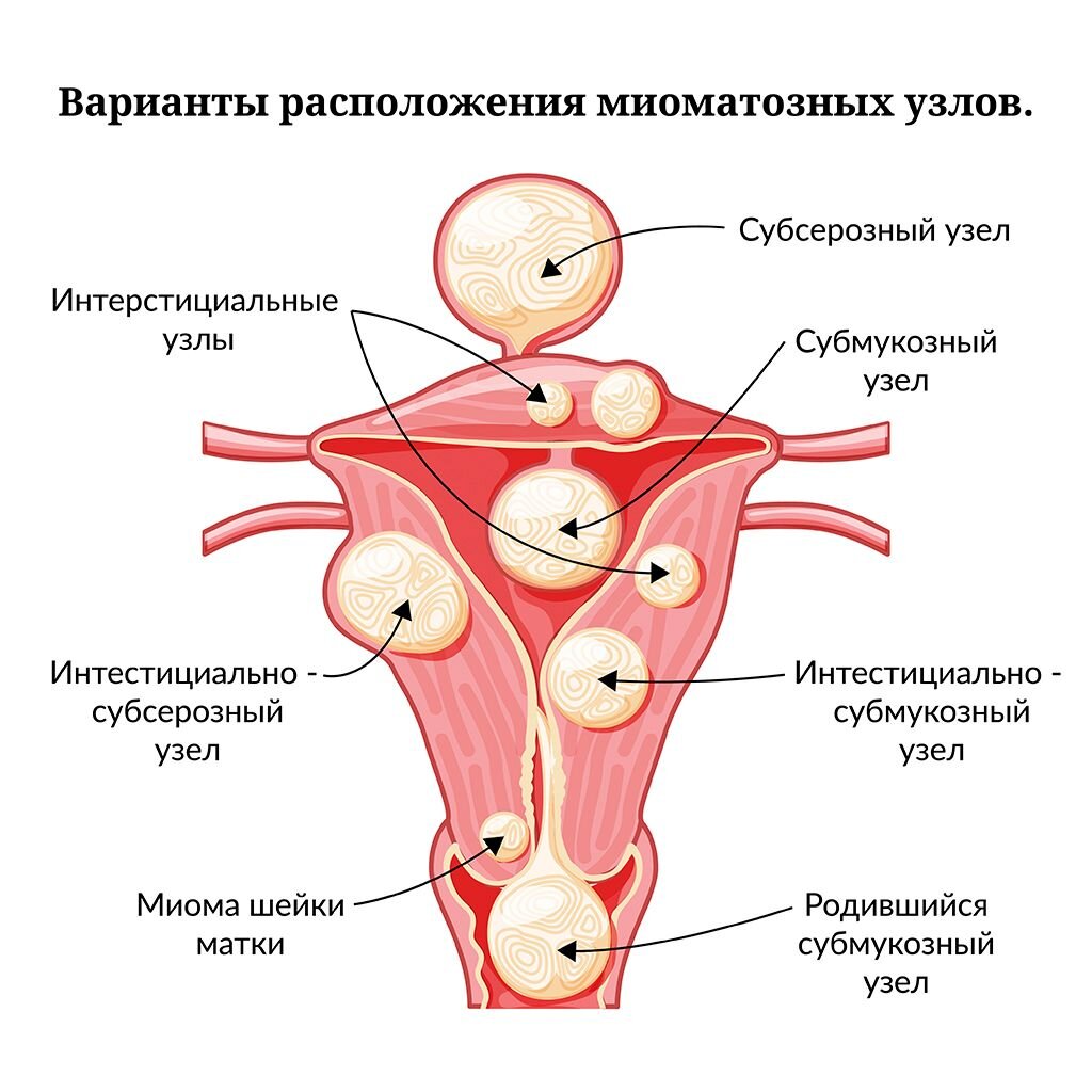 Миома матки: Симптомы, диагностика, лечение миомы и профилактика