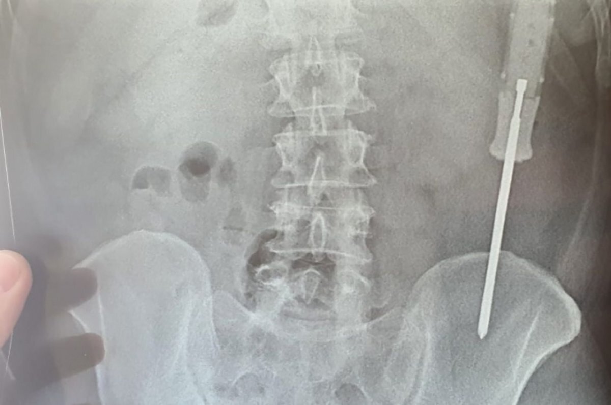    Из одного пациента извлекли отвертку.