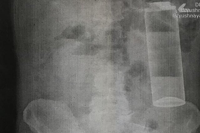    Пациент с баллончиком Фото: Из архива героя публикации