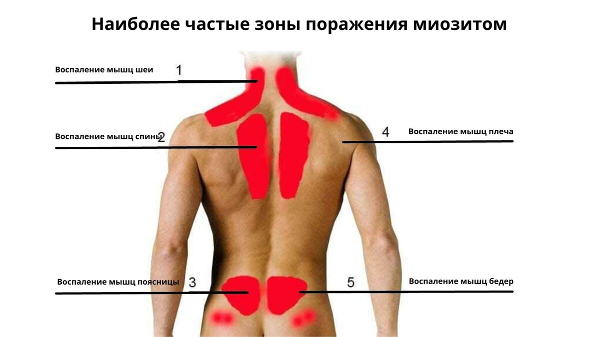 Симптомы миозита шеи у взрослых. Воспаление мышц миозит. Воспаление мышц поясницы.