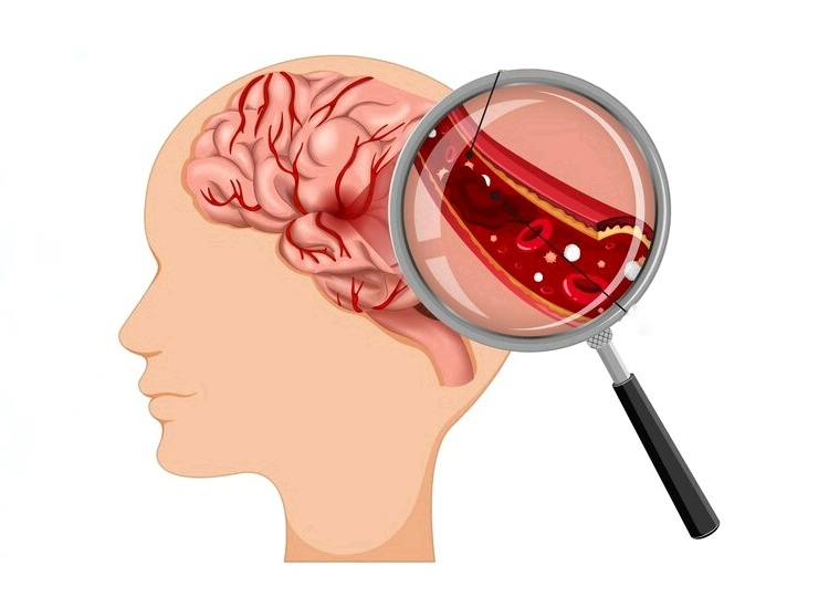 Как улучшить кровообращение мозга. Причины плохого кровотока, последствия и полезные продукты