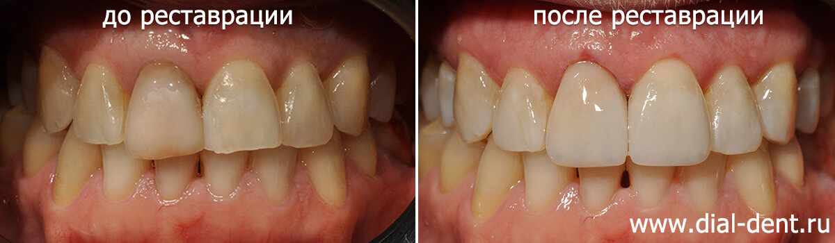 Реставрация переднего зуба композитом