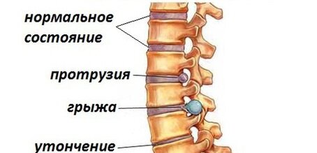 Различные заболевания позвоночника 