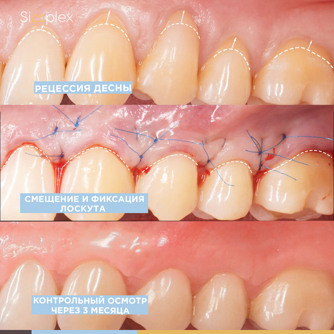 Микрохирургическое закрытие рецессий, врач-пародонтолог Александр Лазарев