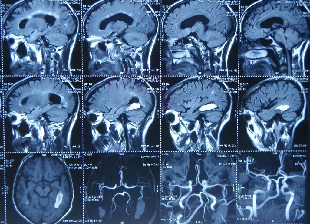 Спб головного мозга. Магнитно резонансные томограммы головного мозга. Кт томограмма головного мозга. Кт (компьютерная томография) сосудов головного мозга. Магнитно-резонансная томография (мрт) сосудов головного мозга.