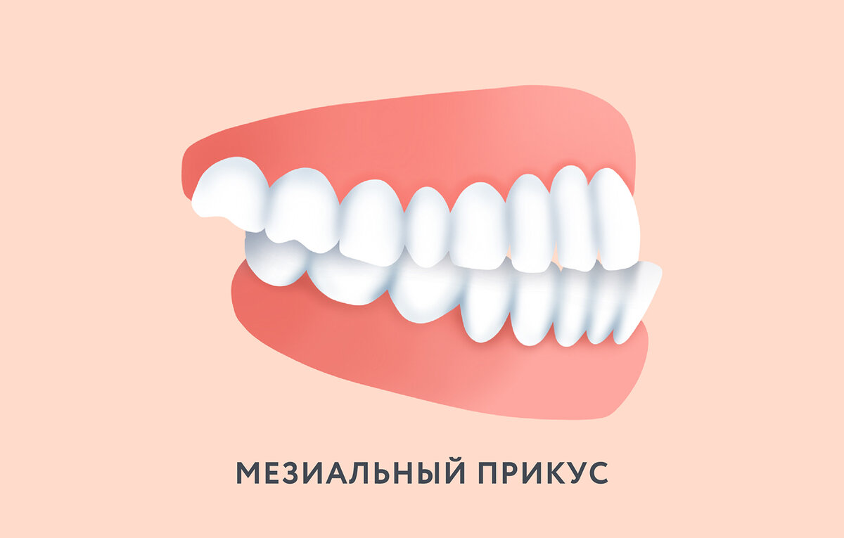 Мезиальный прикус: фото до и после лечения у взрослых и детей | Dental Art