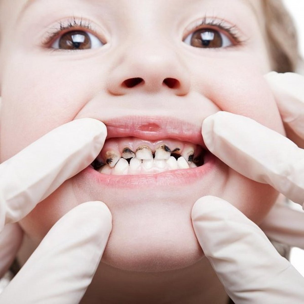 
👋 Привет! В этой статье мы рассмотрим одну из распространенных проблем устной гигиены - черные пятна на зубах.