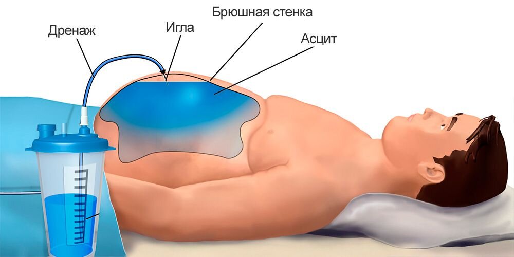 Что такое водянка и откуда она берется?