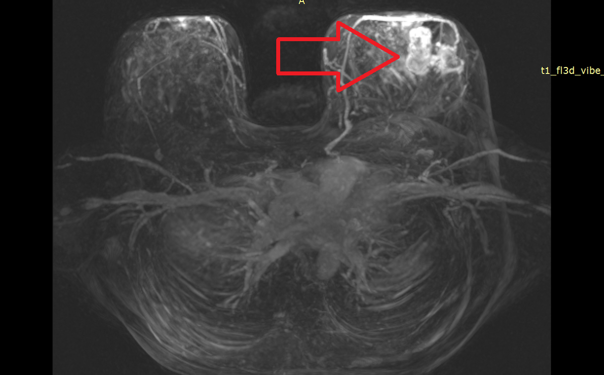 РЕЦИДИВ МАСТИТА СПУСТЯ 10 ЛЕТ ИЛИ ОПУХОЛЬ? СЛУЧАЙ ИЗ ПРАКТИКИ ...