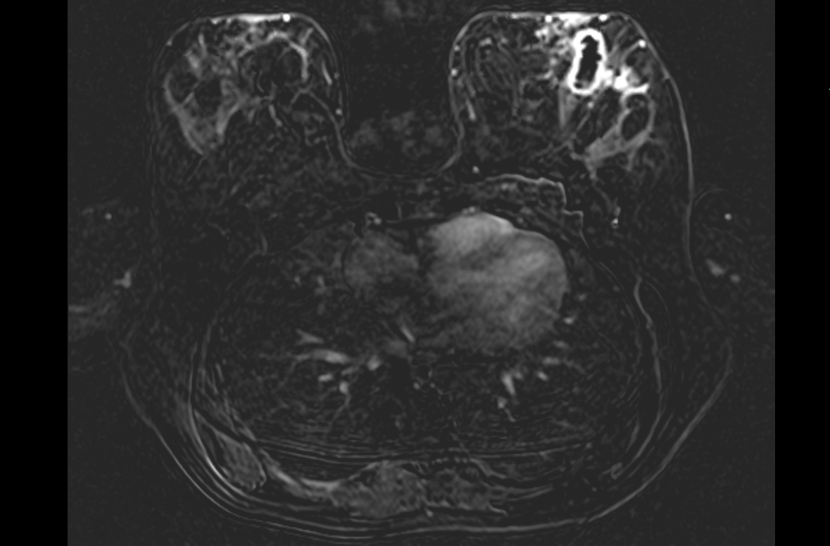РЕЦИДИВ МАСТИТА СПУСТЯ 10 ЛЕТ ИЛИ ОПУХОЛЬ? СЛУЧАЙ ИЗ ПРАКТИКИ ...