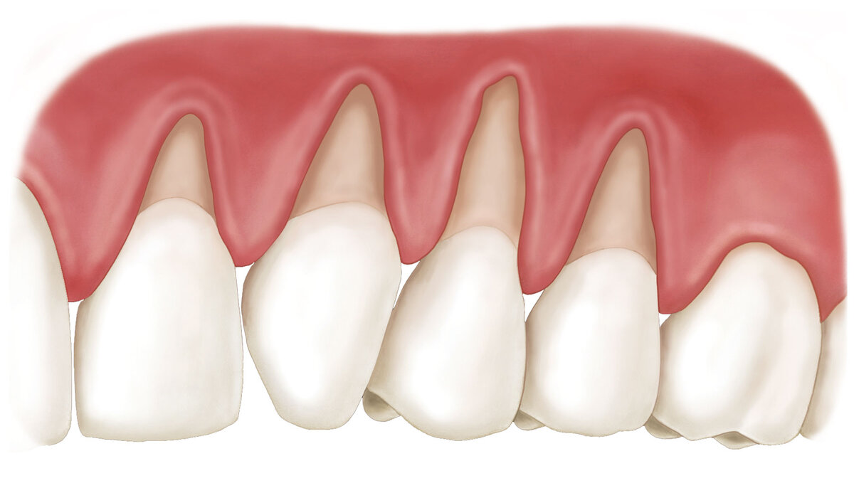 Рецессия десны