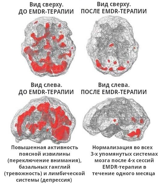 Результаты SPECT-сканирования головного мозга до и после EMDR-терапии 