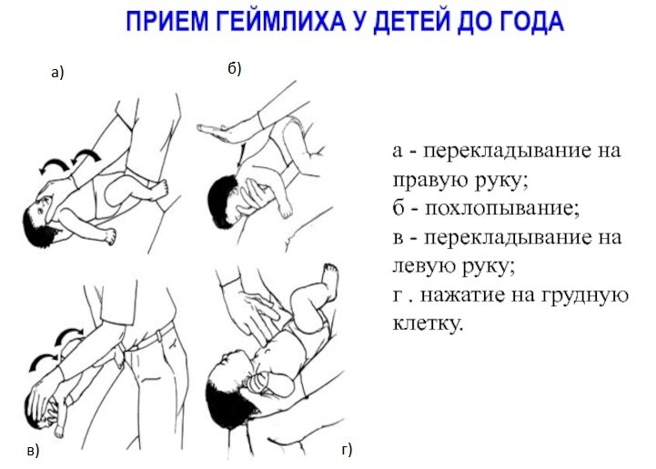 Это должен знать и уметь каждый: абдоминальные толчки или приём Геймлиха Красное