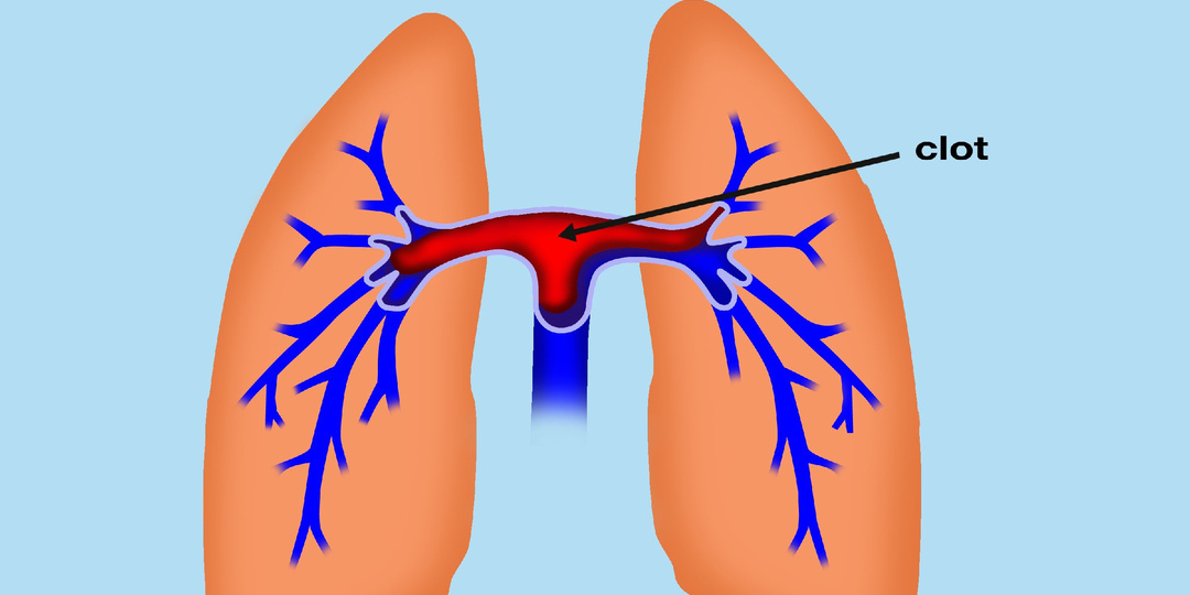 Откуда "отрывается" тромб?