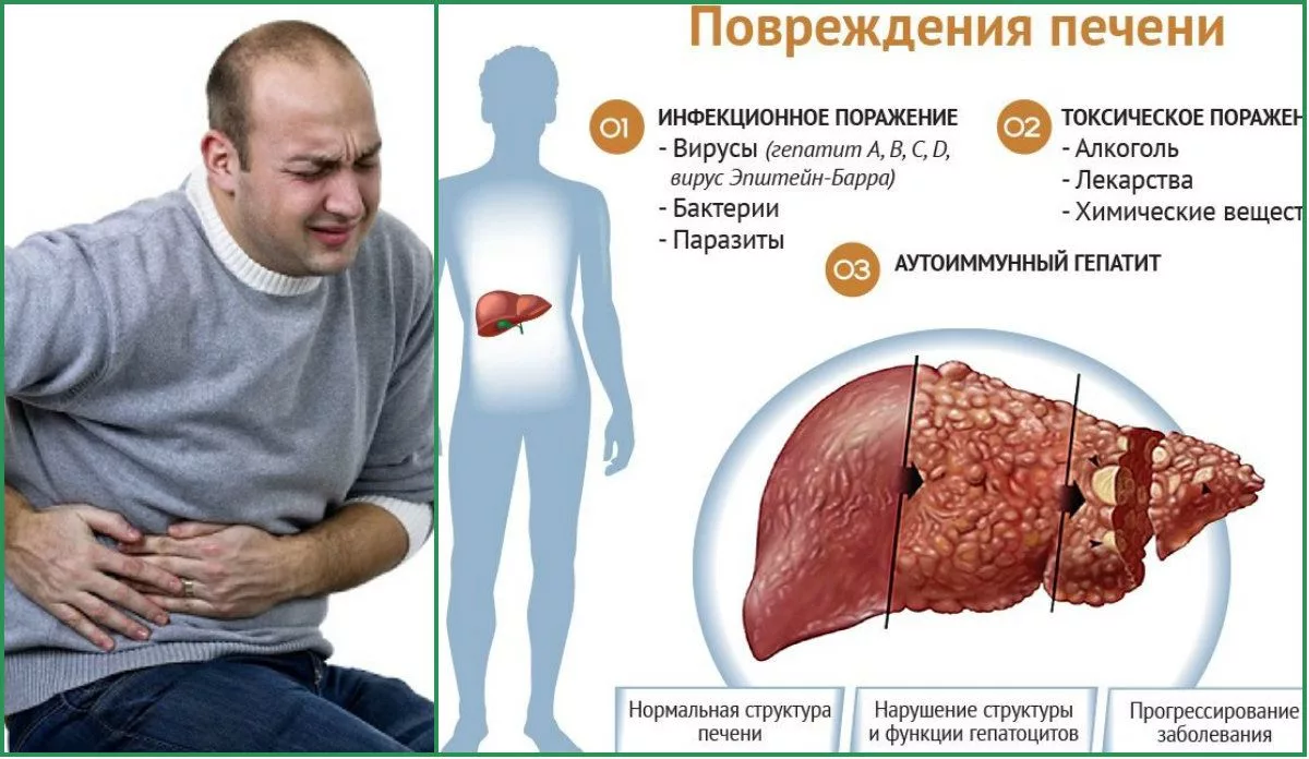 Причинами цирроза печени, помимо всем известных алкоголизма и гепатита, могут становиться жировой гепатоз и болезни.-3