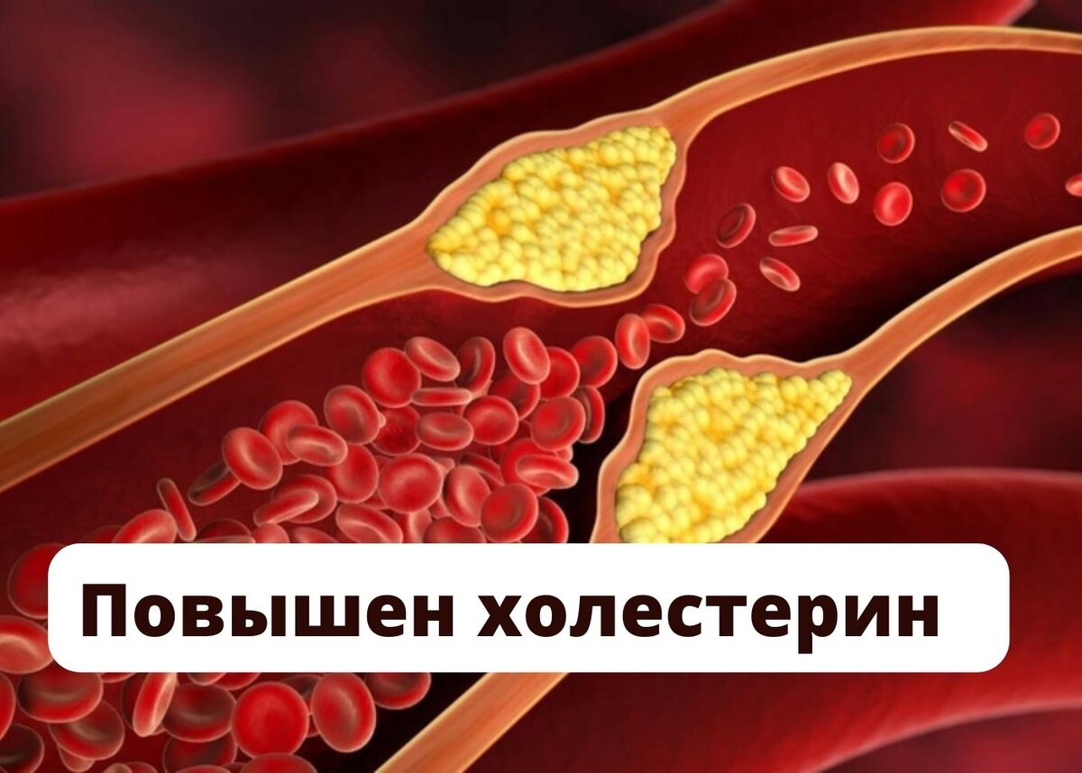 Кофе повышает холестерин в крови. Холестерин. Высокий холестерин человек. Иконка высокий холестерин.