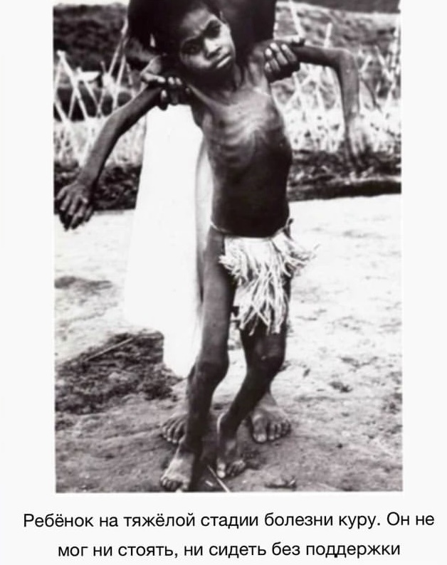 Болезнь куру: как заболевают и возможно ли вылечиться ? | Доктор ...