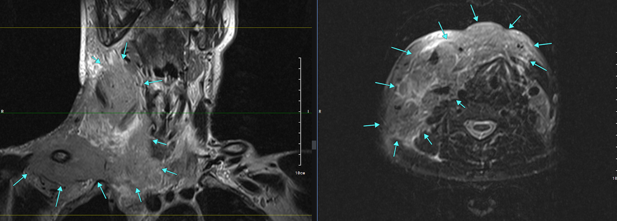 Рис. 1. Т2 корональная плоскость и Т2 FS аксиальная плоскость. Массивный объемный процесс в области передней и правой боковой поверхности шеи [стрелки]