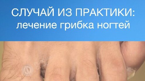 КЛИНИКА ПОДОЛОГИИ ПОЛЁТ | СЛУЧАЙ ИЗ ПРАКТИКИ: лечение грибка ногтей ...