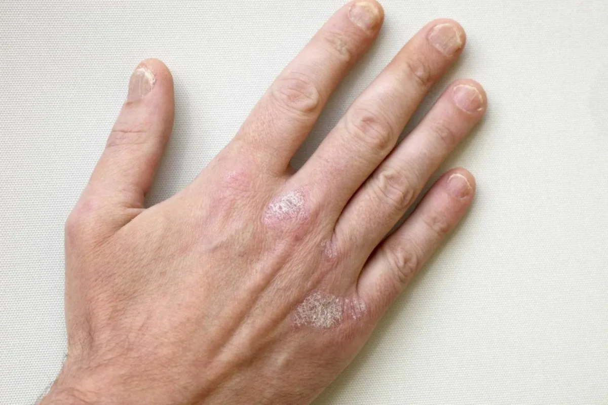 Что такое псориаз и как он отличается от экземы или кожной аллергии!