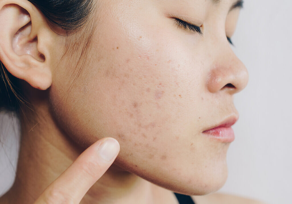 Изображения по запросу Acne