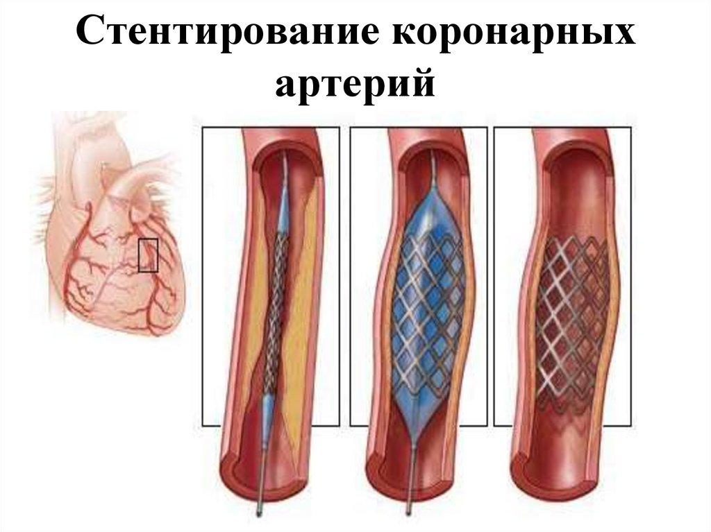 Установка стента может и не нести никакой пользы - странно, правда же?)) А может спасать жизнь.